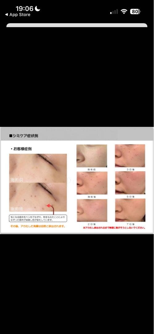 【未使用　新品】低周波シミ取り　未使用　ペンシルタイプ　業務用