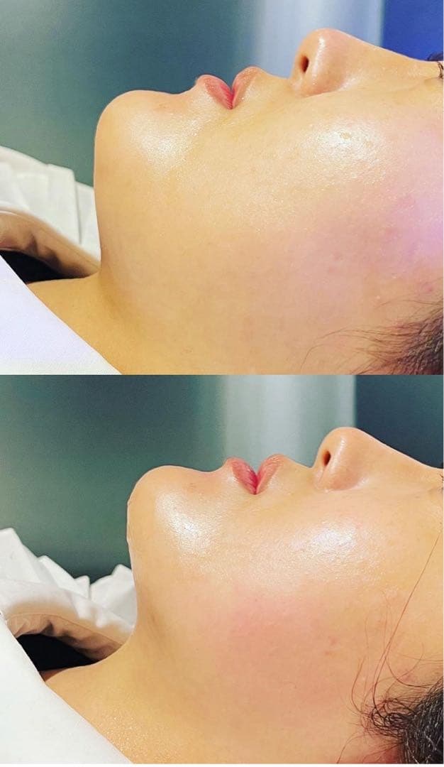 効果実証済　業務用美容機器LDM 水玉リフティング　超音波美肌マシン