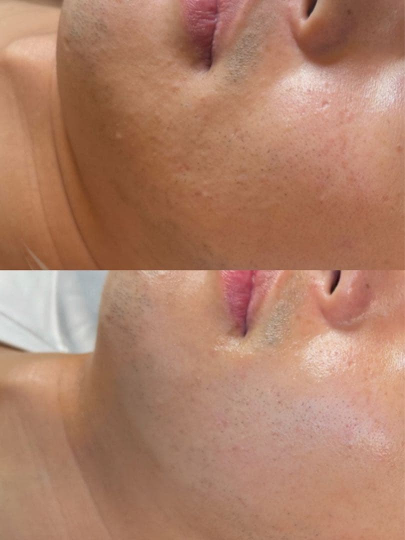 効果実証済　業務用美容機器LDM 水玉リフティング　超音波美肌マシン