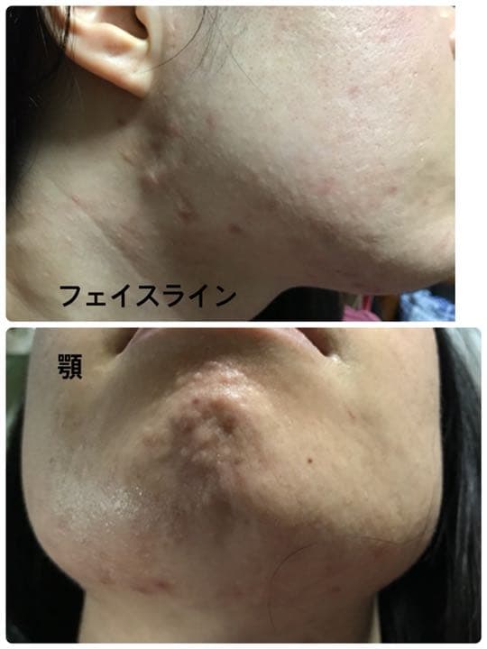 バイオプトロン2 美品　10万円大幅値下げ