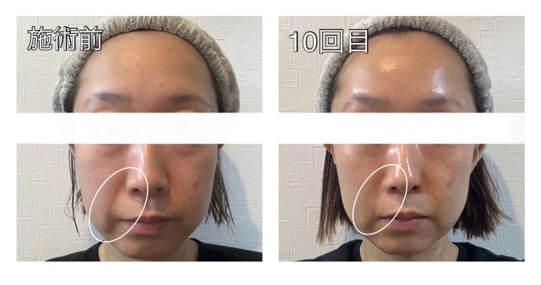 サロン使用✨新品未開封 エレクトロポレーション 美顔器 約30％OFF❗️